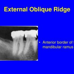 Internal and external oblique ridge