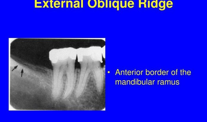 Internal and external oblique ridge